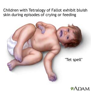 Children with Tetralogy of Fallot exhibit bluish skin during episodes of crying or feeding
