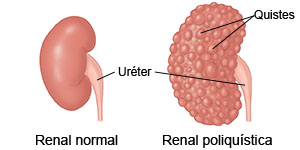 Riñón normal.  Riñón poliquístico