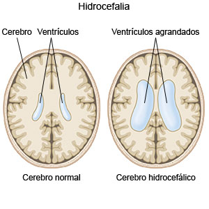 Hidrocefalia 