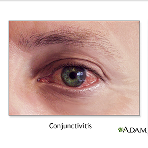 Conjunctivitis