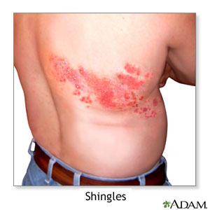 Shingles