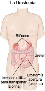 Urostomía