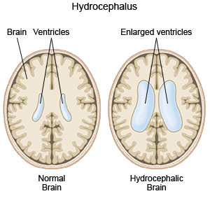 Hydrocephalus 