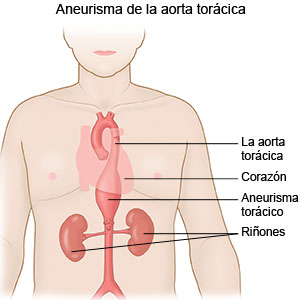 Aneurisma de la aorta torácica 