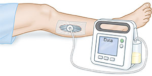 Negative Pressure Wound Therapy THA