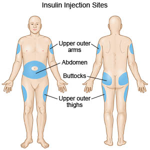 Insulin Injection Sites