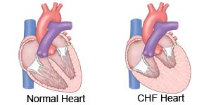 Normal Heart  CHF Heart