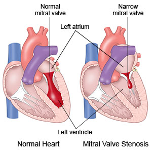 Normal mitral valve  Narrow mitral valve