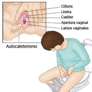 Autocateterismo: