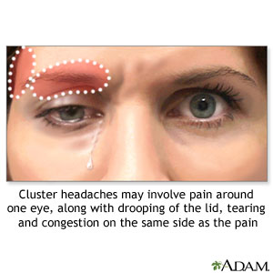 Cluster headaches may involve pain around one eye, along with drooping of the lid, tearing and congestion on the same side as the pain