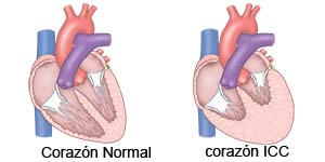 Corazón normal y corazón con ICC