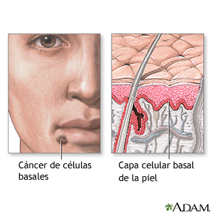 Cáncer basocelular. Capa basal epidérmica