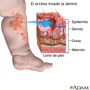 La ectima invade la dermis