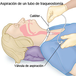 Aspiración de un tubo de traqueostomía