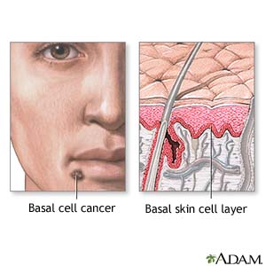 Basal cell cancer  Basal skin cell layer