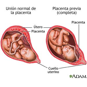 Fijación normal de la placenta. Placenta previa (completa)
