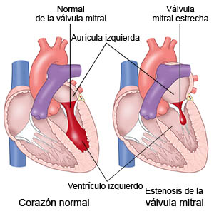  Válvula mitral normal. Válvula mitral estrecha