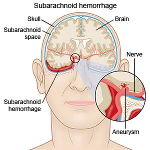 Subarachnoid Hemorrhage