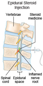 Epidural Steroid Injection