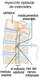 Inyección epidural de esteroides