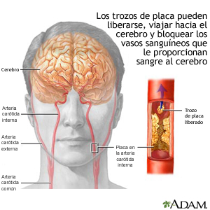 Los pedazos de placa pueden liberarse, llegar al cerebro y bloquear vasos sanguíneos que suministran sangre al cerebro