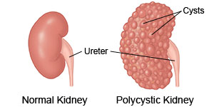 Normal Kidney  Polycystic Kidney