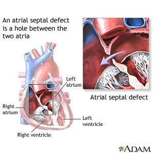 Atrial Septal Defect