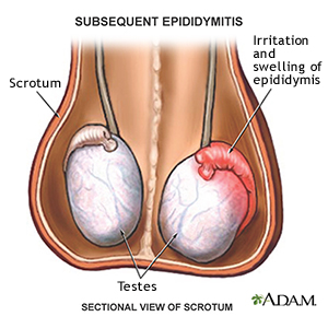 Subsequent Epididymitis