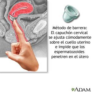 Método de barrera: El tapón cervical se adapta perfectamente sobre el cuello uterino, previniendo que los espermatozoides ingresen al útero