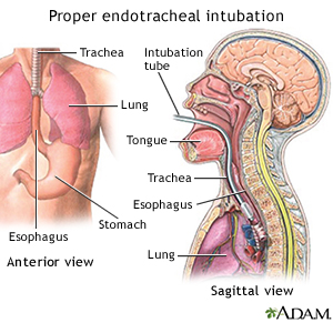 Proper Endotracheal Intubation