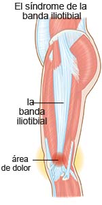 Síndrome de la banda iliotibial