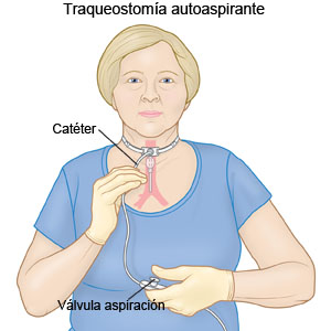 Auto aspiración en traqueostomía