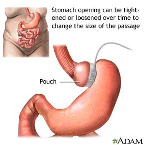 Stomach opening can be tightened or loosened over time to change the size of the passage