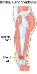 Iliotibial Band Syndrome
