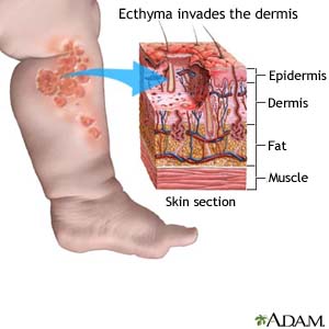 Ecthyma invades the dermis