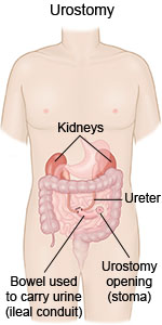 Urostomy