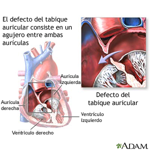 Defecto septal auricular