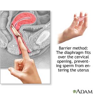Barrier method: The diaphragm fits over the cervical opening, preventing sperm from entering the uterus