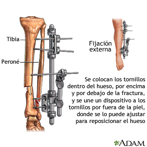 Fijación externa: