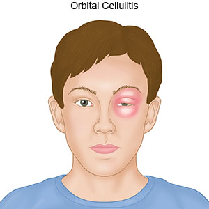 Orbital Cellulitis