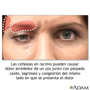 En las cefaleas histamínicas puede producirse dolor alrededor de un ojo, jcaída del párpado, lagrimeo y congestión en el mismo lado que el dolor