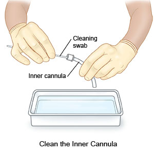Clean the Inner Cannula