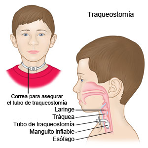 Traqueostomía 