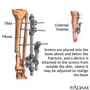 External Fixation