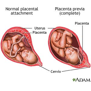 Normal placental attachment  Placenta previa (complete)