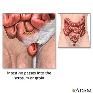 Intestine passes into the scrotum or groin
