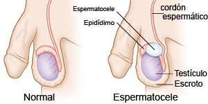 NORMAL/ESPERMATOCELE