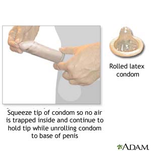 Squeeze tip of condom so no air is trapped inside and continue to hold tip while unrolling condom to base of penis