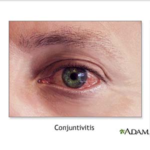 Conjuntivitis