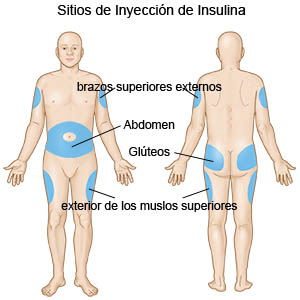Sitios de la inyección de insulina